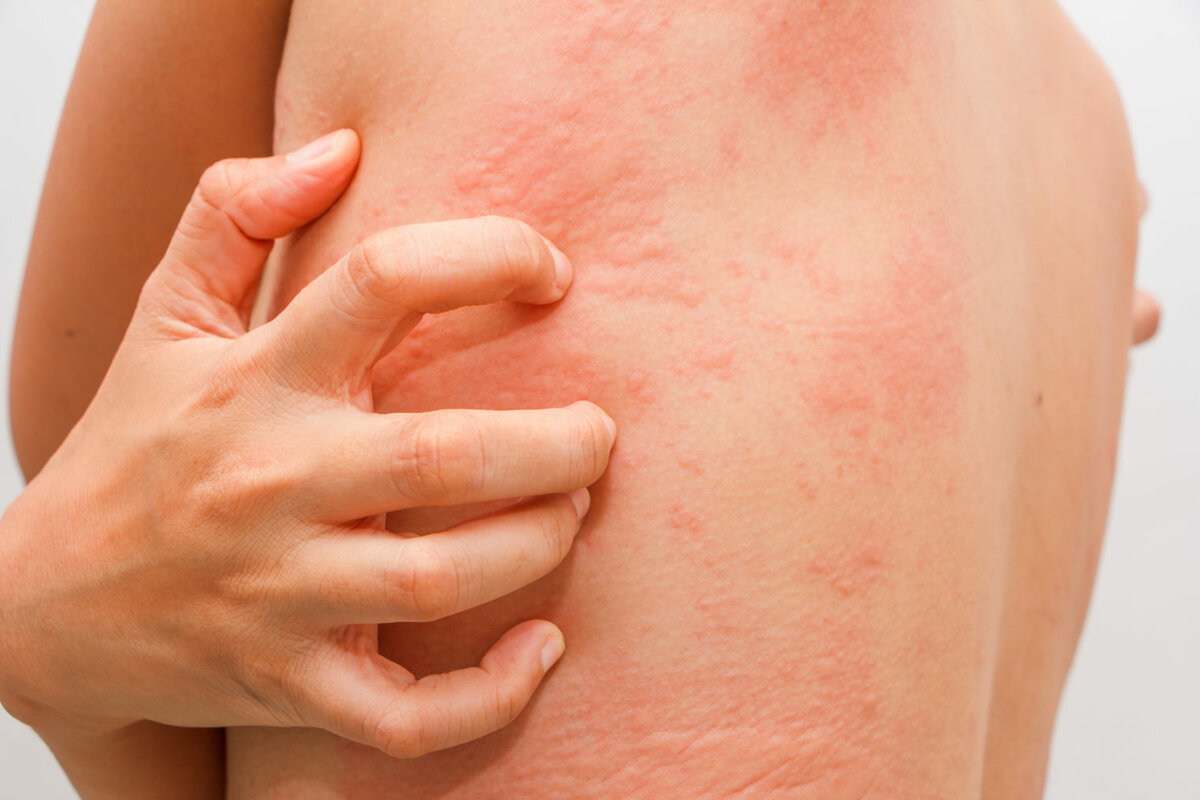 Аллергический отек гортани - чем опасен, как реагировать и как лечить?