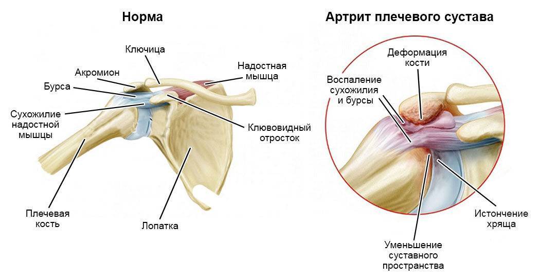 Артроз плечевого сустава у спортсменов - noltrexsin