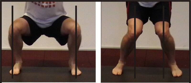Пателлофеморальный артроз коленного сустава - симптомы и лечение