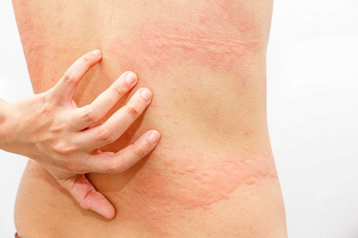 Аллергия на хлорку: симптомы, способы лечения, меры предосторожности