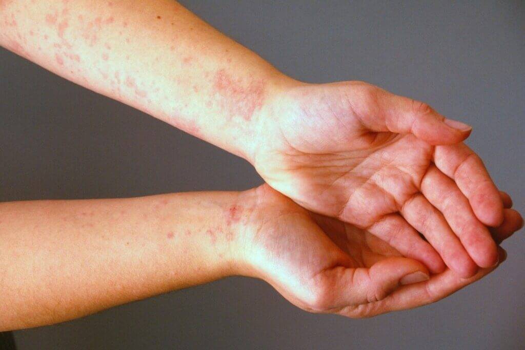 Аллергия на хлорку в бассейне – симптомы у детей и взрослых
