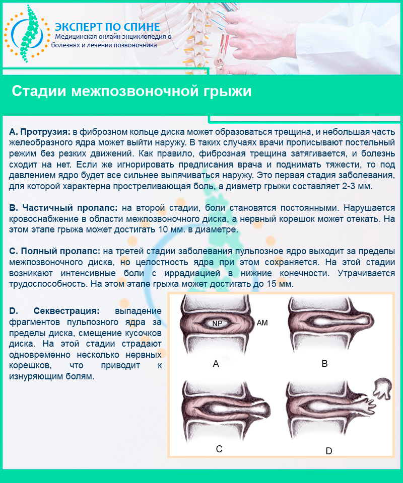 Протрузия дисков шейного отдела позвоночника — лечение в спб