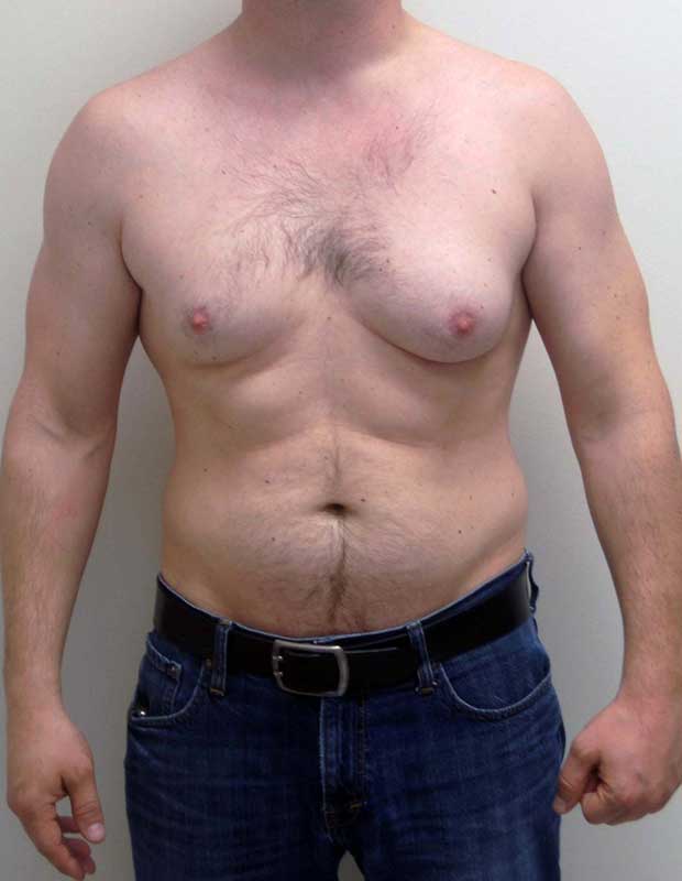 Гинекомастия. когда у мужчины увеличена грудь