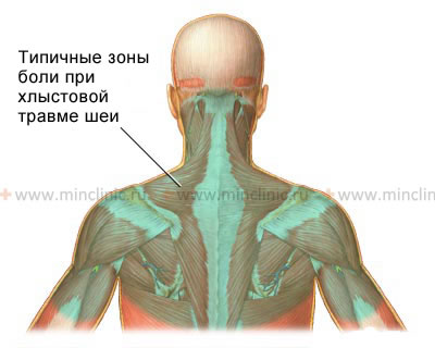 Затылок шею плечи. Шейно-черепной синдром м53.0 что это.