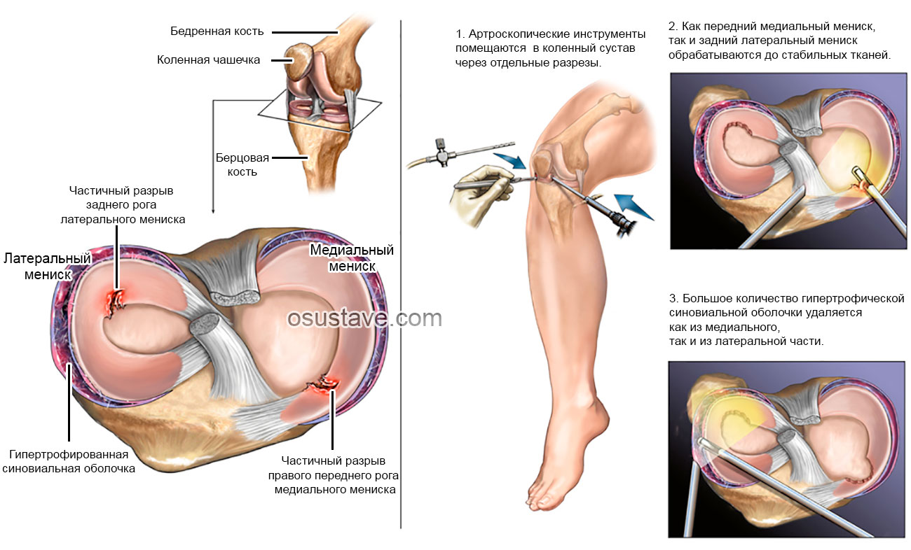 Повреждения мениска коленного сустава как лечить. Разрыв рога заднего мениска 3 стадии. Повреждение заднего рога медиального мениска Stoller. Разрыв медиального мениска коленного сустава 3а. Повреждение медиального мениска 2 степени.