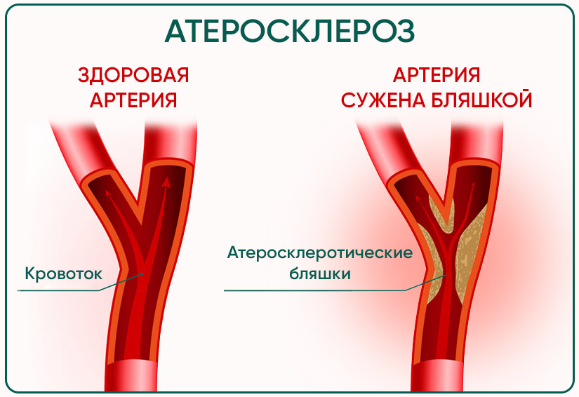 Риск атеросклероза. Бляшки в сосудах норма у мужчин по возрасту таблица. Средний уровень холестериновых бляшек в артериях у мужчин 50 лет.