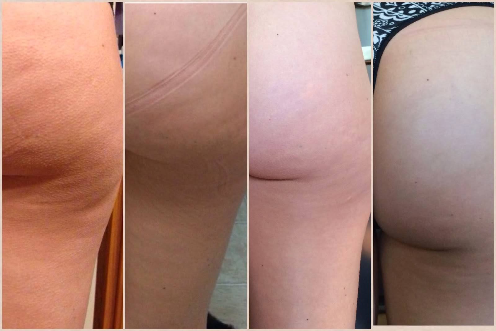 Особенности подтяжки бедер | myplasticsurgeon.ru
