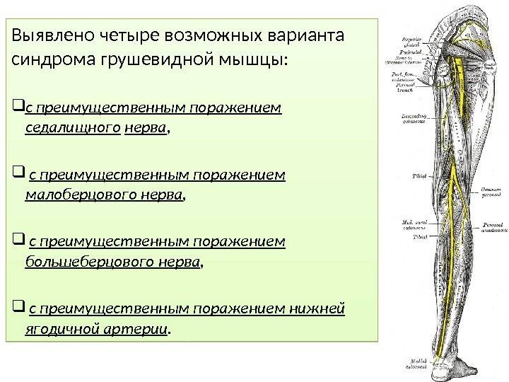 Синдром грушевидной мышцы. лечение