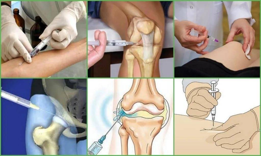 Лечение артроза коленного сустава - нолтрекс.