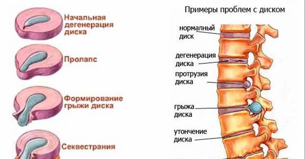 Протрузия дисков позвоночника что это такое и как лечить фото