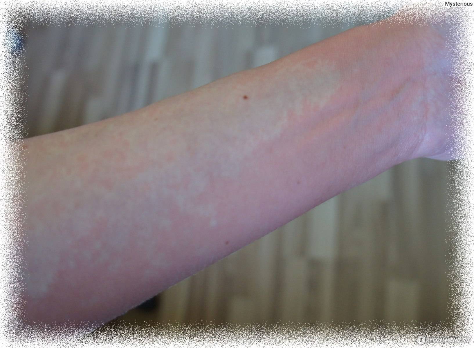 Аллергия на хлорку в бассейне – симптомы у детей и взрослых