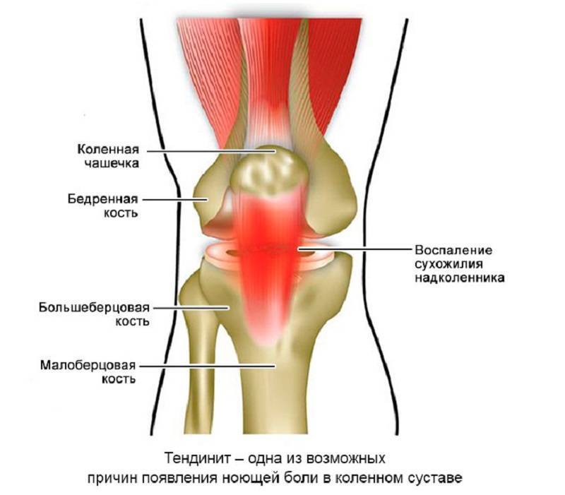 Боль в колене при вставании после сидения: причины, лечение, профилактика