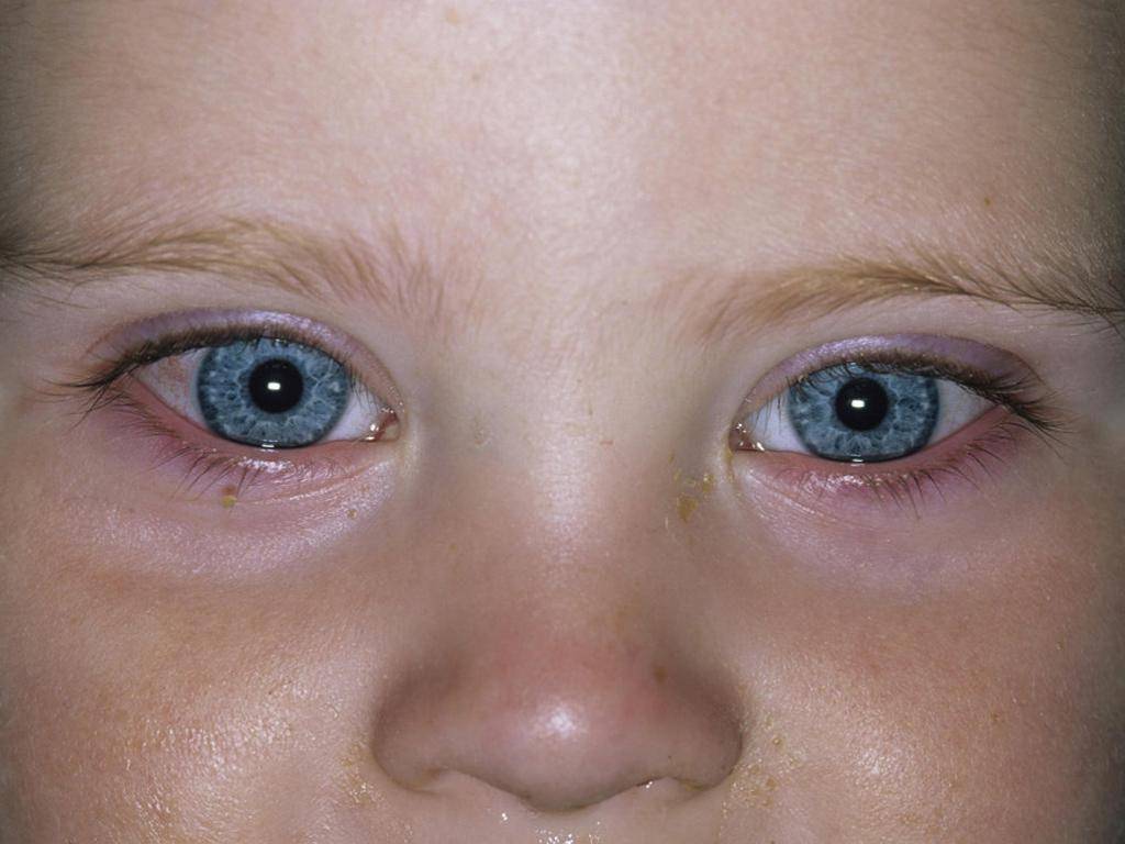 Отек квинке у детей - симптомы, первая помощь и лечение ангиоотека | детский аллерголог см-клиника