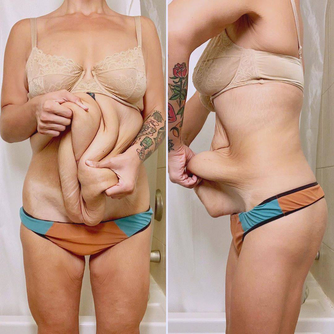Как подтянуть грудь после похудения